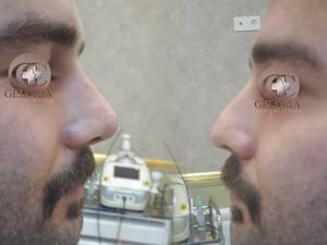 فرم دهی بینی