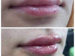 تزریق ژل لب و فرمدهی لب با ماندگاری بالا