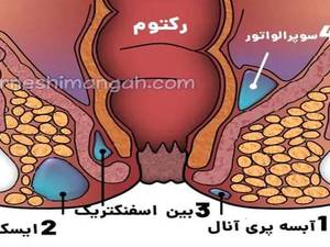 آبسه مقعدی چیست؟