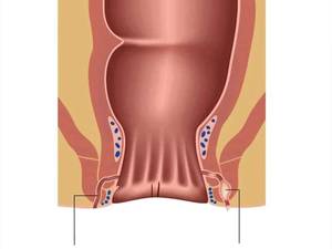 فیستول مقعدی چیست؟