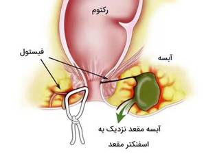 فیستول مقعدی چیست؟
