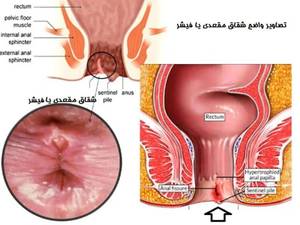 درمان شقاق مقعد 