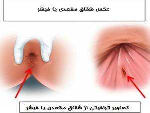 درمان شقاق مقعد 