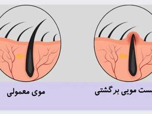 کیست موئی یا سینوس پایلونیدال چیست؟