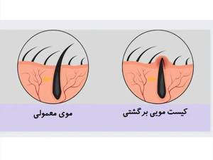 کیست موئی یا سینوس پایلونیدال چیست؟