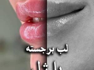 تزریق ژل لب طبیعی و ارزان در تهران