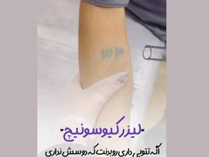 بهترین مرکز لیزر کیوسوئیچ در لاهیجان