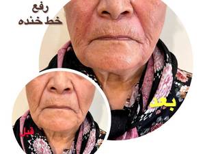 هزینه از بین بردن خط خنده در تهران