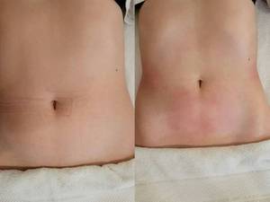 بهترین روش لاغری موضعی شکم و پهلو در بندرماهشهر