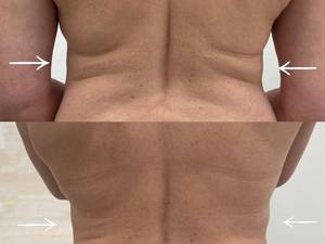 مرکز لاغری با دستگاه کرایو در بندرماهشهر