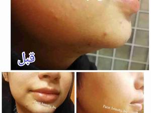 تزریق ژل به چانه