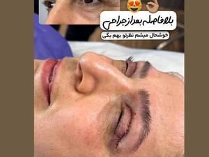 جراحی افتادگی پلک بالا در لاهیجان