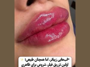 تزریق فیلر لب طبیعی در لاهیجان