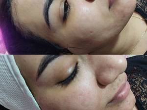 پوست کره ای سینرژی پیل الگاپیل در اهواز