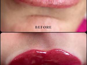 شیدینگ لب بدون درد در کرمانشاه