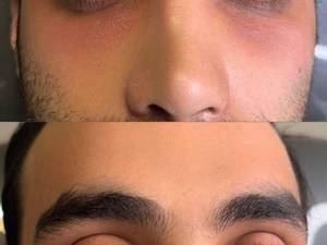 هزینه فیلر زیر چشم در شریعتی تهران