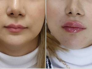 تزریق ژل لب نیم سی سی در میرداماد تهران