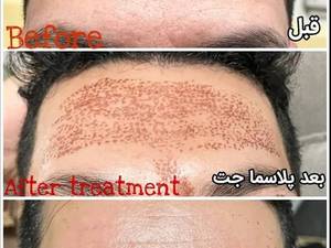 خدمات تزریق بوتاکس پیشانی در اهواز