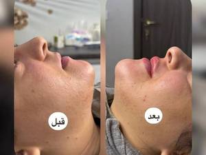 تزریق فیلر لب طبیعی در در لاهیجان