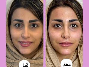 کانتورینگ صورت با ظاهری طبیعی در لنگرود