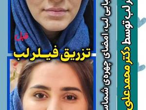 تزریق فیلر لب بدون درد با ماندگاری بالا در رشت