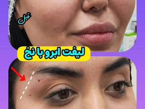 کلینیک لیفت ابرو با نخ در رشت