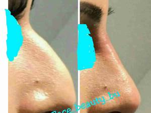 اصلاح قوز بینی