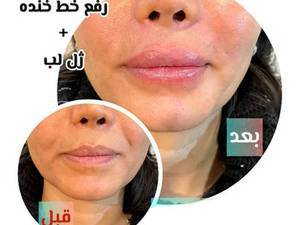 رفع خط خنده و خط اخم بصورت تخصصی در تهران