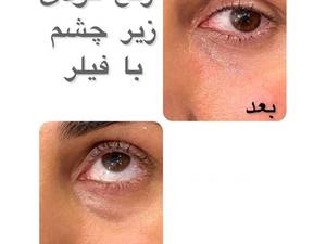 هزینه رفع گودی زیر چشم با تزریق فیلر تخصصی در تهران