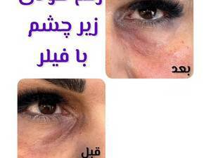 هزینه رفع گودی زیر چشم با تزریق فیلر تخصصی در تهران