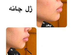 تزریق ژل و فیلر چانه در بهترین کلینیک زیبایی در تهران
