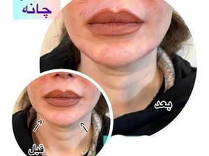 تزریق ژل و فیلر چانه در بهترین کلینیک زیبایی در تهران