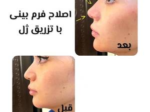 اصلاح فرم بینی با تزریق ژل