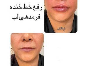 تزریق ژل لب استاندارد و با کیفیت بالا