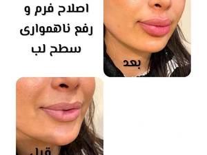 تزریق ژل لب استاندارد و با کیفیت بالا