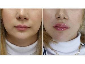 خدمات تزریق فیلر لب با کیفیت تضمینی در تهران