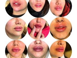 خدمات تزریق فیلر لب با کیفیت تضمینی در تهران