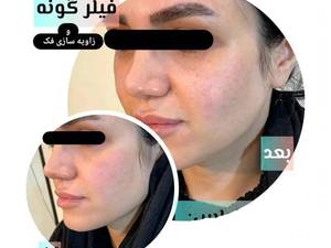 فیلر گونه و فرم‌ دهی طبیعی بدون جراحی در تهران