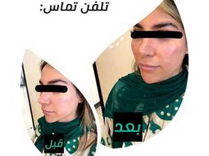 فیلر گونه و فرم‌ دهی طبیعی بدون جراحی در تهران