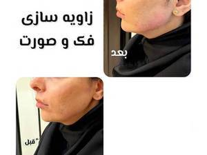 زاویه‌سازی فک، صورت و کانتورینگ صورت