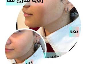 زاویه‌سازی فک، صورت و کانتورینگ صورت