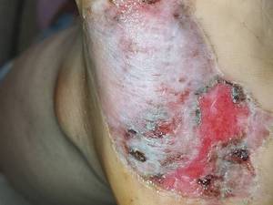 کلنیک زخم دیابتی نعمتی در آمل