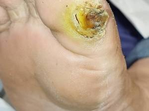 درمان زخم دیابتی نعمتی در آمل