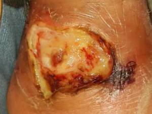 درمان زخم نوروایسکمیک