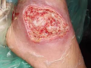 درمان زخم نوروایسکمیک