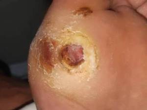 درمان قطعی نوروپاتی دیابتی