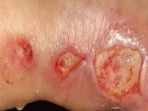 درمان قطعی زخم بستر