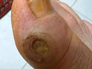 درمان جدید نوروپاتی دیابتی