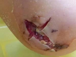 درمان زخم جراحی هماتوم دیابتی