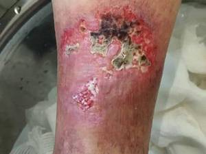 درمان زخم وریدی ساق پا